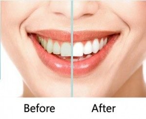 Zoom Teeth Whitening